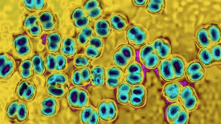 Meningitis.